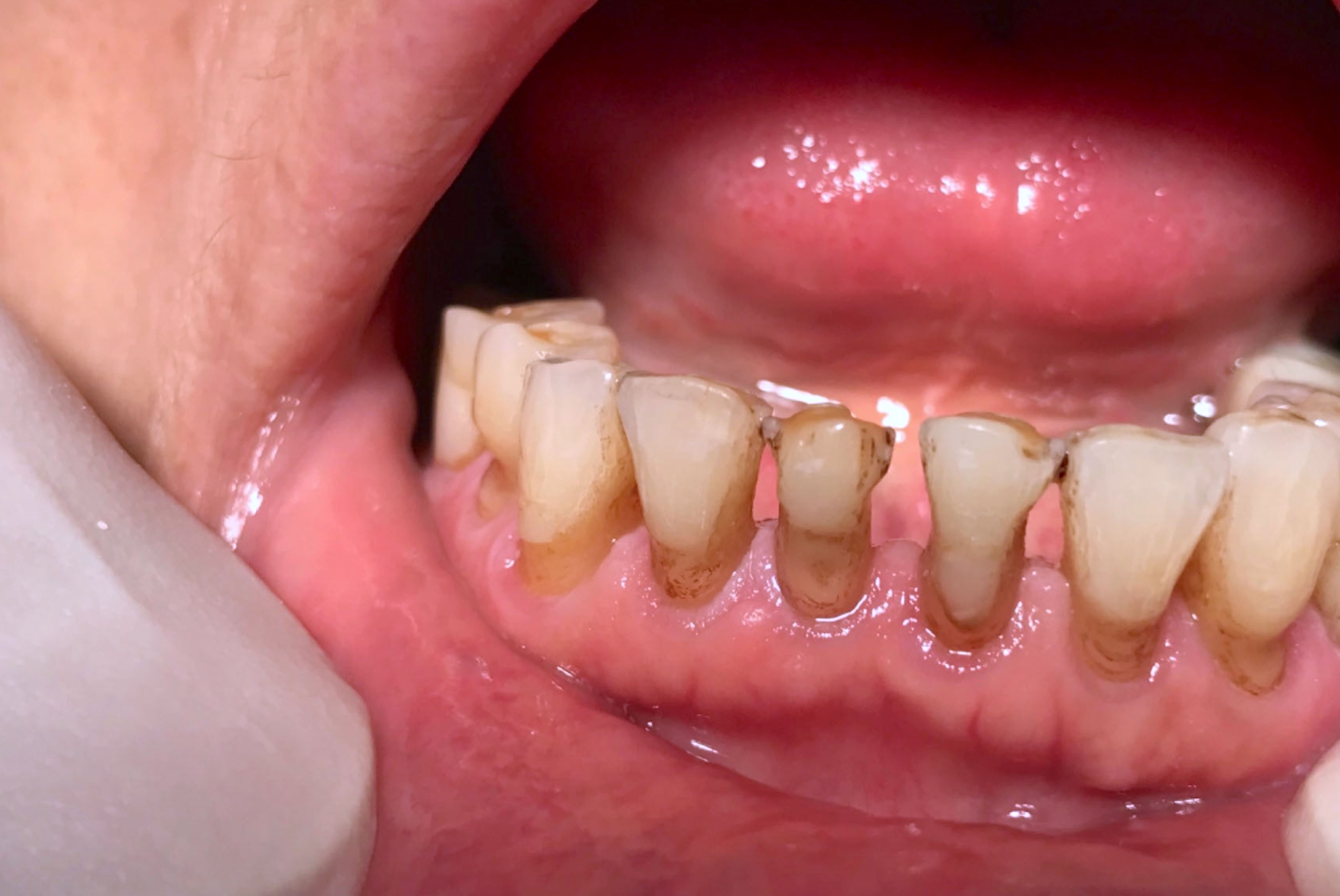 Before treatment